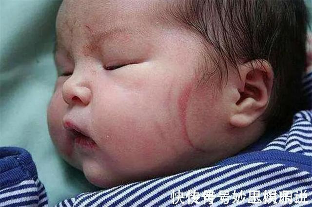 产钳|宝宝出生3个月，脸上“产钳印”明显，儿媳遭婆婆责备“没本事”