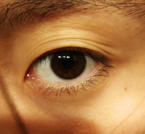 你的眼皮都有几层了?