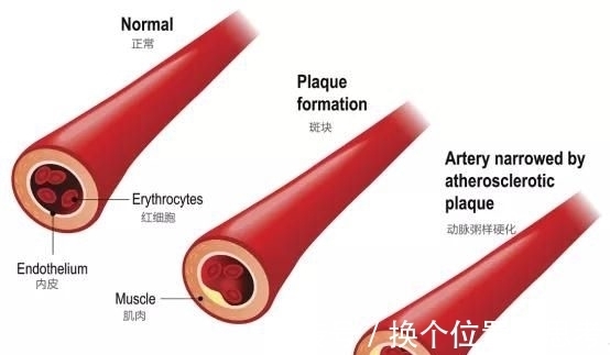 血管硬化|中科西部干细胞研究院：干细胞治疗高血脂，有效改善血管硬化！