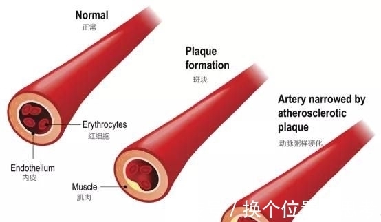 干细胞|中科西部干细胞研究院:干细胞治疗高血脂,有效改善血管硬化!