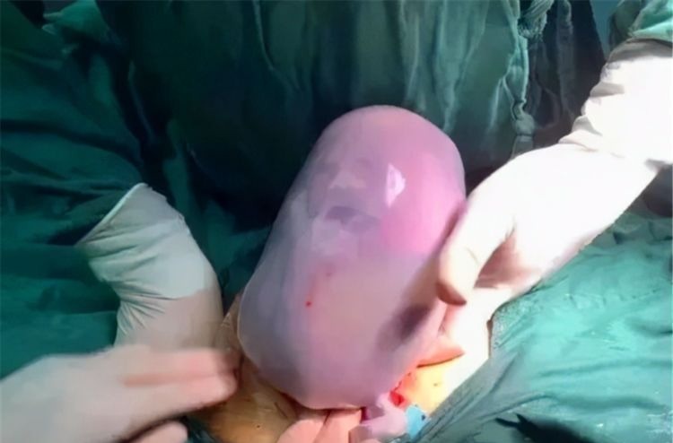 陪产|90后宝妈生出“果冻宝宝”,陪产宝爸吓得脸发白,医生却说:恭喜