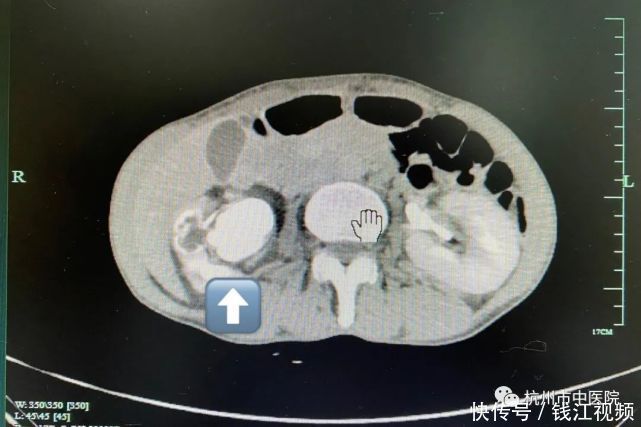 疯狂|从“疯狂的石头”到一口袋碎石子再到脓毒血症,这都经历了什么啊