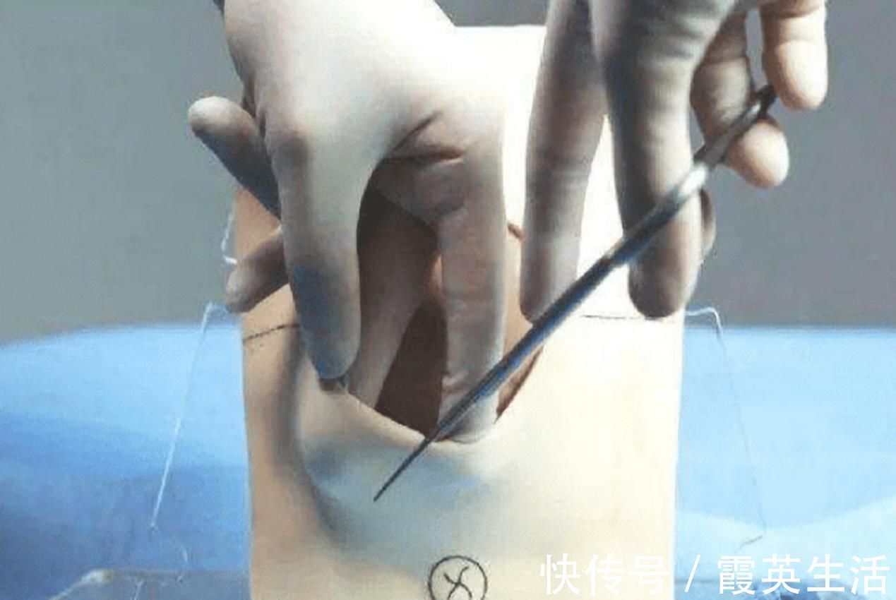 侧切|顺产也可能“挨一刀”,自然撕裂和人为侧切,孕妈更愿意接受哪个