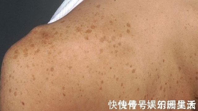 老年斑|肝脏也要“洗洗澡”,别让肝毒招来肝硬化,威胁我们身体