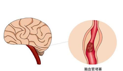  能就是脑|脑梗发作前，身体会亮起“红灯”，若能早点察觉，或能降低伤害
