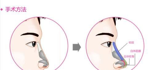 你去隆鼻之后 术后鼻部歪斜你会怎么办？