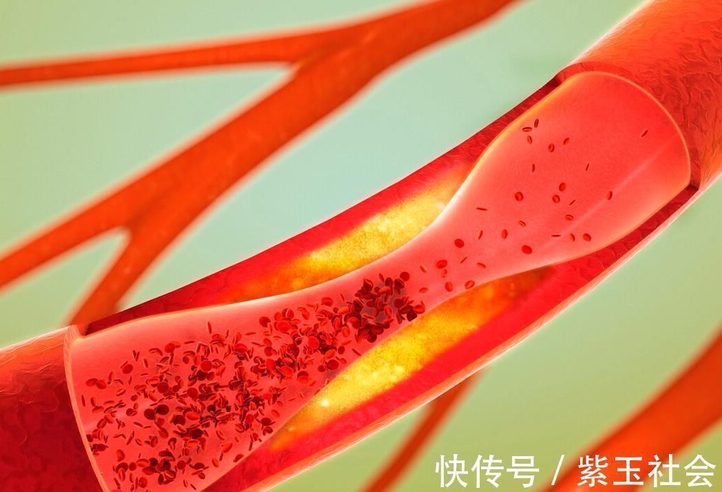 骨髓|高血脂的人,最好别碰3种食物,多吃一口,血脂都升,别不当回事