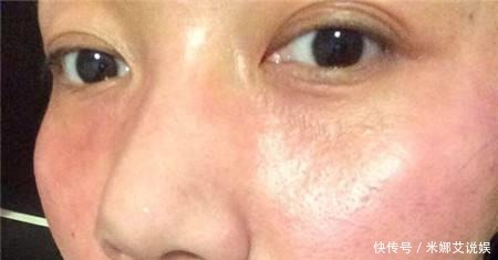 全网|你的护肤方式上黑名单了吗?辟谣10个火爆全网的烂脸护肤伪科学