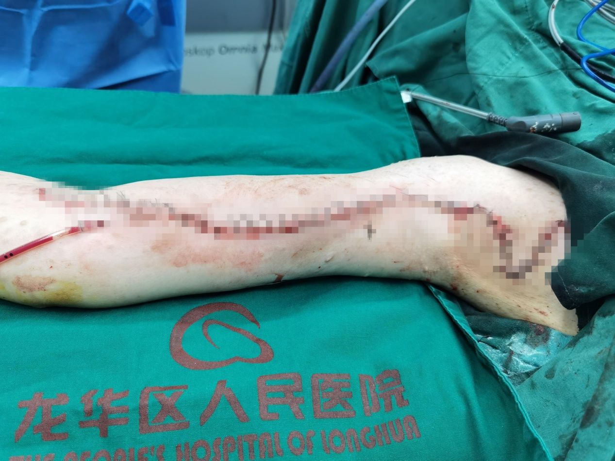 肿瘤|罕见！胳膊上长出排球大的肿瘤 医生成功完整切除