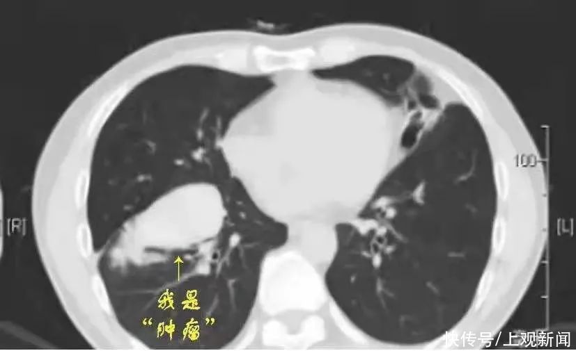 支气管|神逆转！被诊断为“肺癌”差点去开刀，结果竟是……