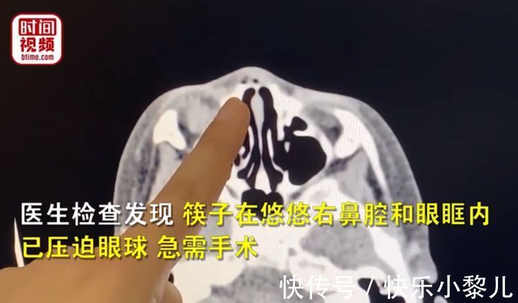 想想都疼!2岁女娃玩耍不慎摔倒,筷子直插进鼻腔眼眶,压迫眼球