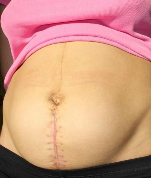 伤口|剖腹产时,伤口缝线处理是用美容线好还是拆线的好?