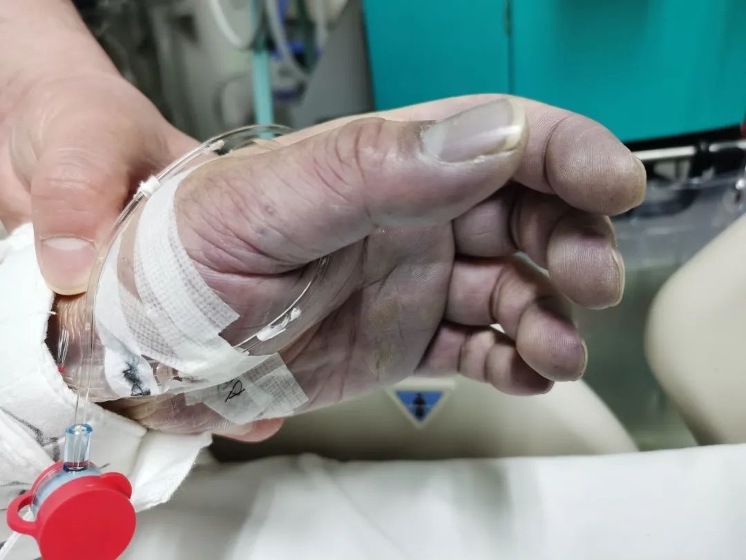 ecmo|北京医院多学科团队应用V-AECMO成功挽救年轻小伙儿生命