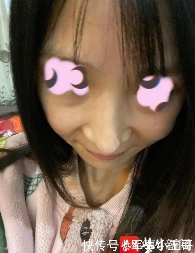 女子整容后山根晃动、鼻尖发白!手术方:很成功,已起诉