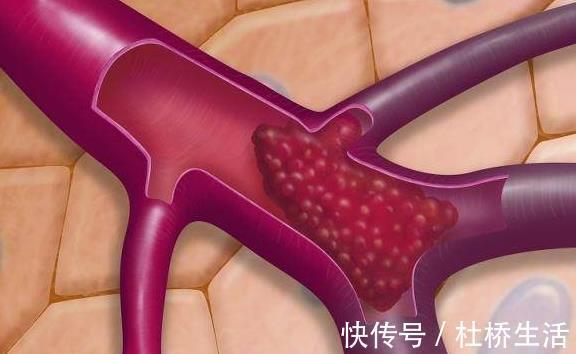 血栓|人体上有个“化栓开关”,每天这样做,不花一分钱,还能防血栓!