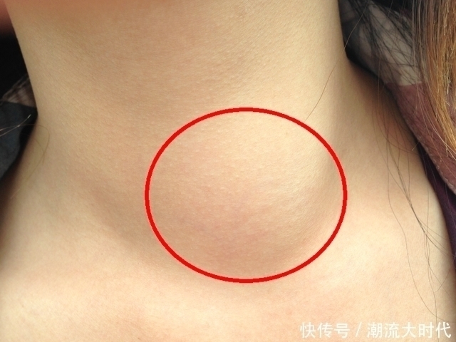 散结|蒲公英茶和菊花茶,哪个消散甲状腺结节好?中医说出答案,别瞎喝