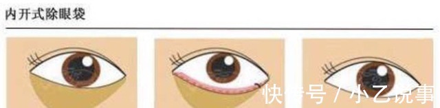 杨主任 杨甄宇眼部整形之祛眼袋手术!