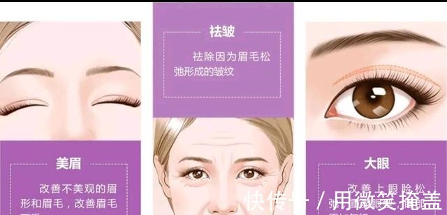 眉毛 提眉手术的优点是!