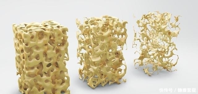 骨骼|骨科院士声明:骨质疏松没那么可怕,睡前常吃1“素”,提高骨密度