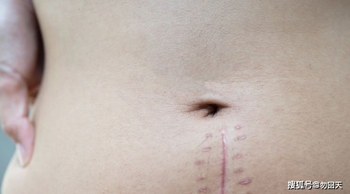切口|剖腹产手术时，为何有些孕妈是横切，有些却是竖切？原来差别很大