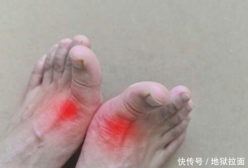 尿酸高小心痛风发作,喝水加它可防痛风,牢记这6点可保命