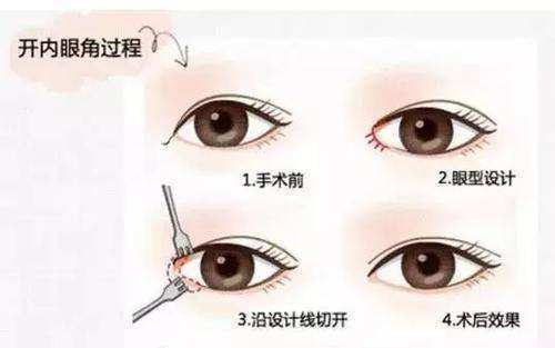 明明只是想割个双眼皮，医生为啥还要我开眼角？难道是为了忽悠我的钱？