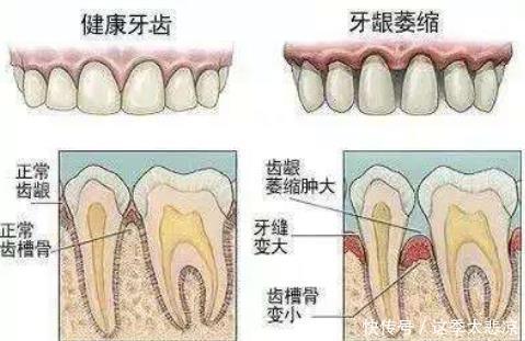  健康|人人都想要拥有一口好牙，牙缝变大，多半是这样原因引起的