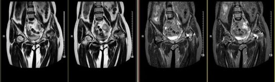 杭州|杭州65岁大伯股骨头坏死，只因他有这个习惯！这几类人是高发人群