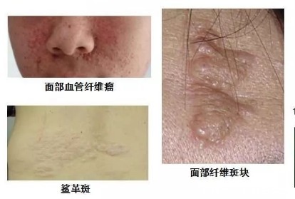 硬化|结节性硬化该如何治疗