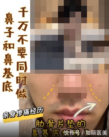 颌面 “鼻基底填充”不能和“隆鼻手术”一起做？听听整形医生怎么说