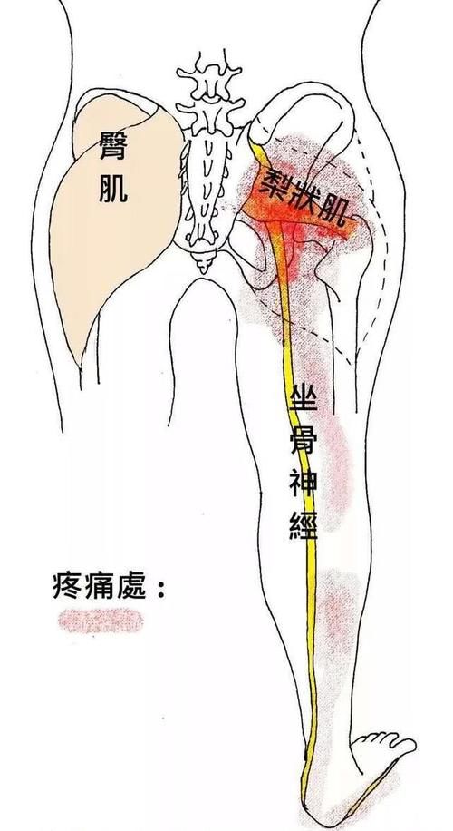 梨状肌 可能是坐骨神经痛和下背部痛的根源 一定要重视起来 快资讯