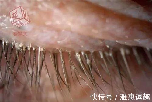 被褥|女子睫毛里长了100多只虫子! 有这个习惯的要当心了