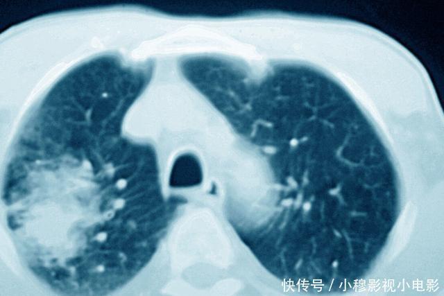 为什么医生总是让癌症患者做CT检查?三大作用,你可能不了解