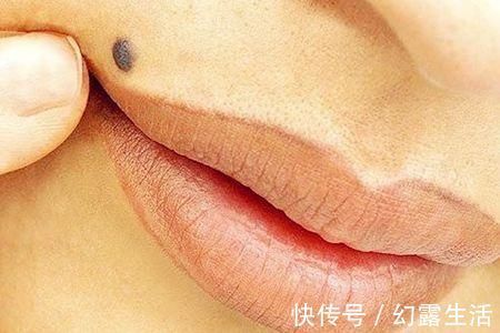 皮肤|皮肤上的痣发生这些变化, 还请尽快去医院找医生就诊!