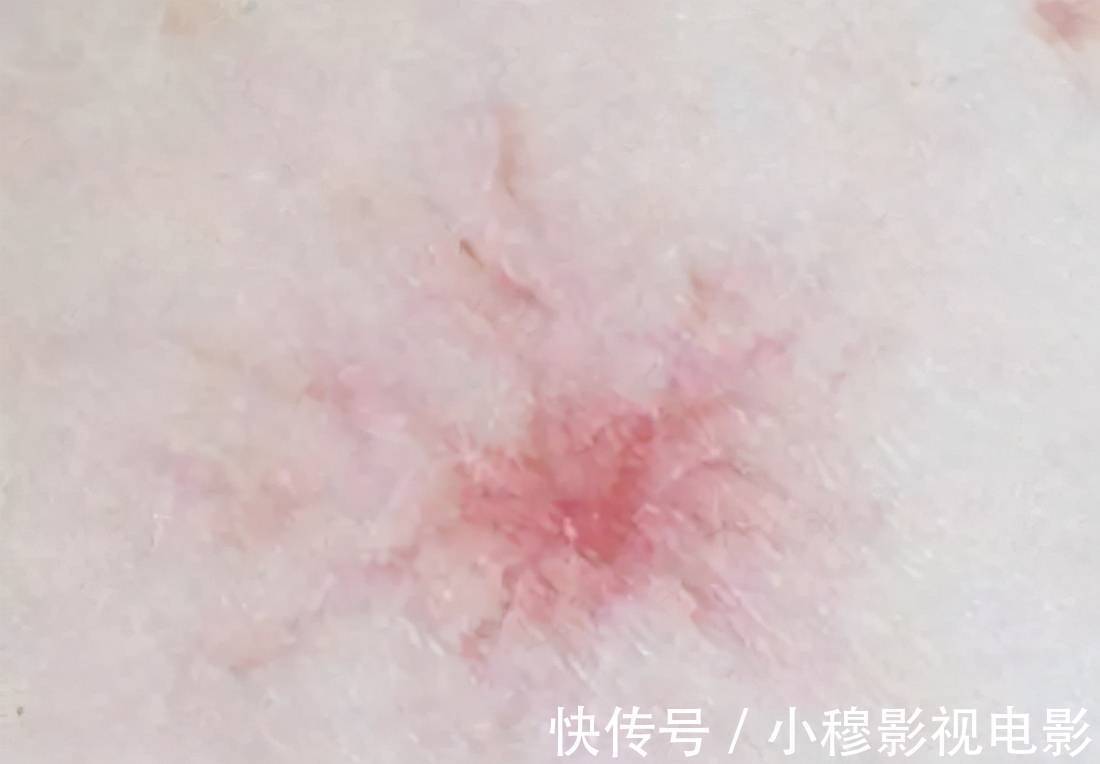 肝癌|身上出现4个小变化,当心肝癌、乳腺癌盯上你!洗澡时看一眼、摸一下能救命