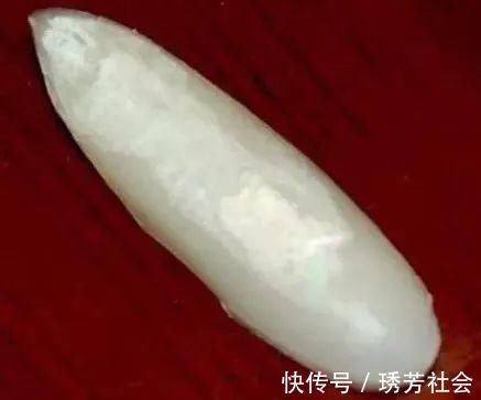 鼻尖|隆鼻后假体要定期更换吗?出现这些情形就该更换假体了!