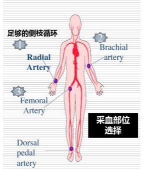 采血|股动脉采血致大面积皮下血肿！采血后按压止血究竟要几分钟？