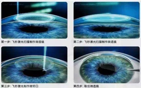 攻略|十一假期有“摘镜”打算？这份激光近视手术攻略一定别错过