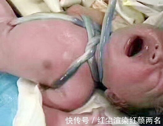 胎儿|孕妇若有4个习惯,容易导致脐带绕颈,怀孕后要及时改掉