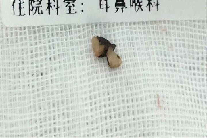 健康过春节|耳鼻咽喉头颈颅底外科:谨防食管异物及小儿气管异物