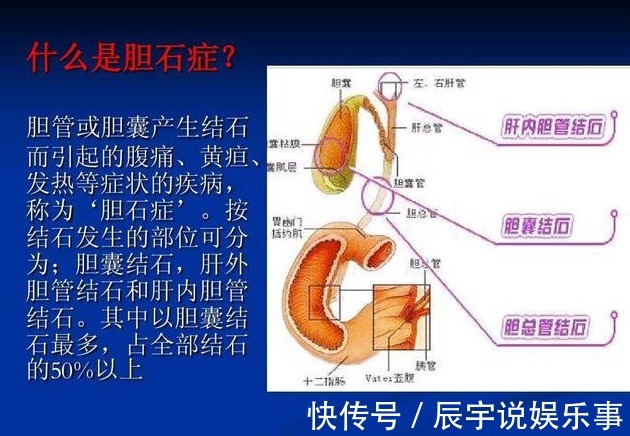 胆囊|胆结石吃什么可以化掉？本文为你揭开不动手术治疗胆结石的真相