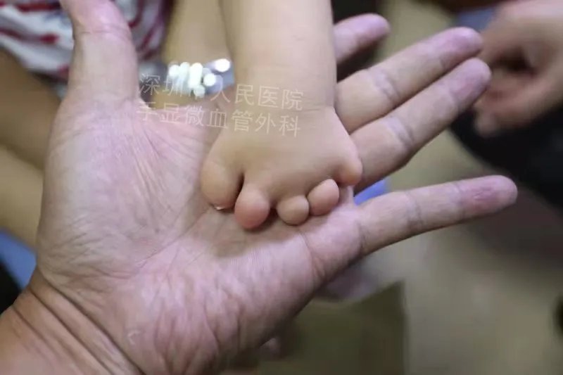 发育不良|得了这病,12岁男孩手指比香蕉还粗!7种常见的手部畸形,家长们要注意