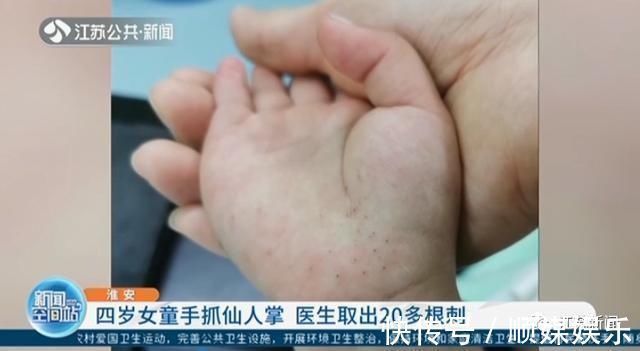 小婷|3岁女童一掌拍在仙人球上,家人处理方式让她的手肿成“小熊掌”