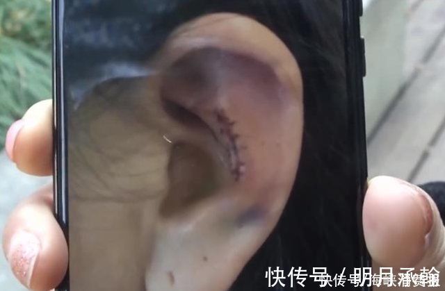 假体 女气取耳朵软骨隆鼻,术后耳朵变形维权未果,医院她本就长这样