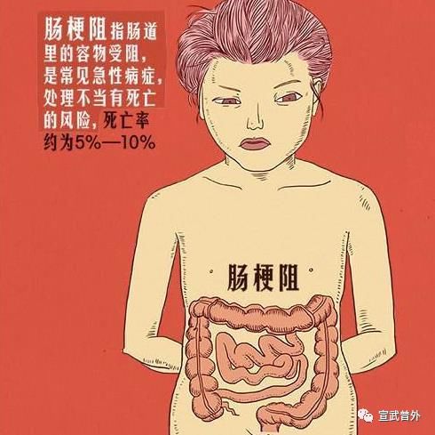 大便|莫让肠子堵,远离肠梗阻