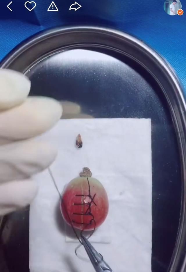 手术|给火龙果割阑尾33岁水果医生爆红吸粉90万网友看到第一个就痛了