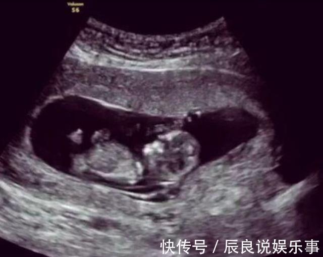 胎儿|孕期38周却“胎死腹中”,这些“孕妇杀手”要预防,准爸妈得留意