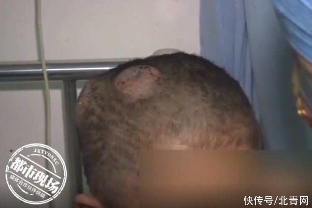 真菌|姐弟俩大量脱发，竟与家中“小可爱”有关