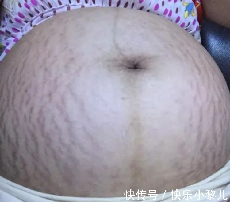 西瓜纹|8个月孕妇抱着西瓜拍孕妇照,看到“西瓜纹”的肚皮,丈夫沉默了