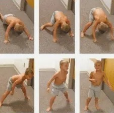 疾病|肌营养不良是怎样一种疾病?如何做到早期识别?